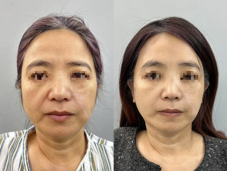 Deep-Plane-Facelift-beforeafter