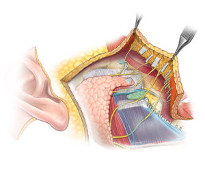 Fig-2-Completely-Releasing-Zygomatic-and-Masseteric-Retaining-Ligaments-in-the-Sub-SMAS-Plane