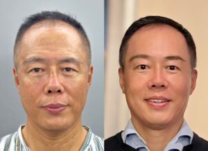 62-year-old man forehead, face, and neck lift surgeries_1