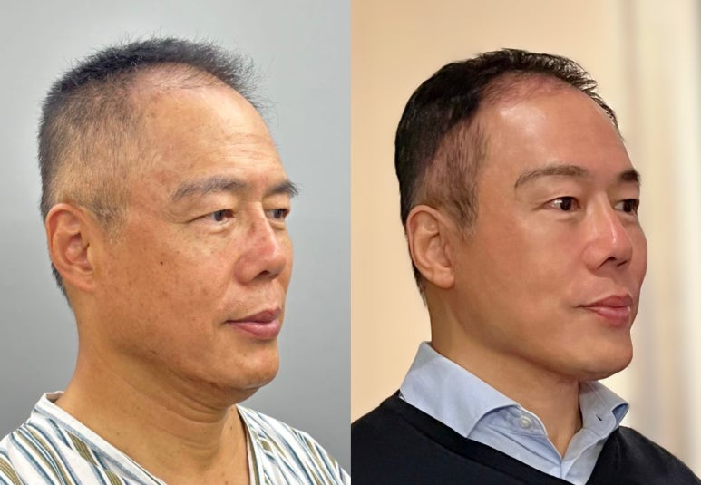 62-year-old man forehead, face, and neck lift surgeries_2