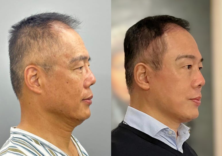 62-year-old man forehead, face, and neck lift surgeries_3