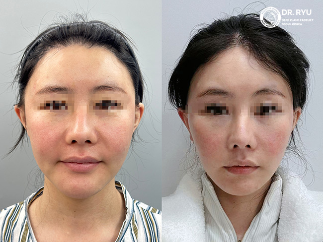 face-lift-before-and-after-young