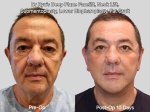 Dr. Ryu’s Deep Plane Facelift CASE 59-Year-Old Male Patient