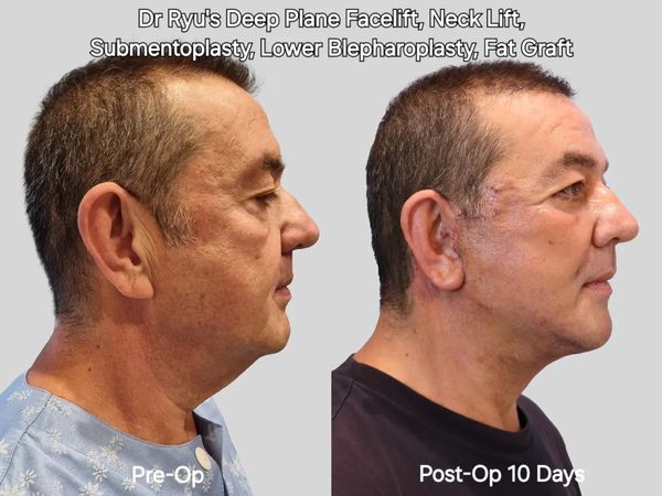 Dr. Ryu’s Deep Plane Facelift CASE 59-Year-Old Male Patient_1