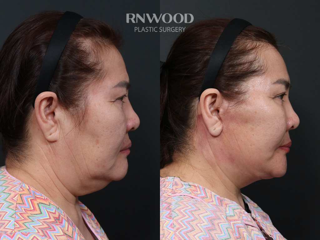 Right profile — case 14