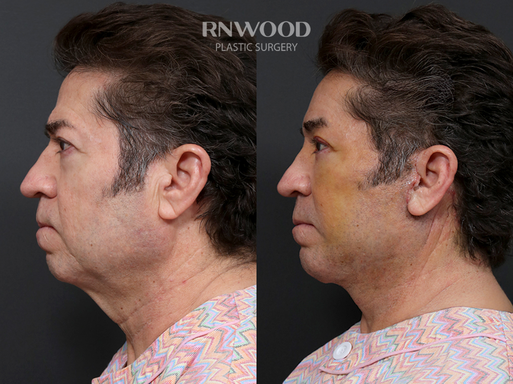 Left profile — case 10