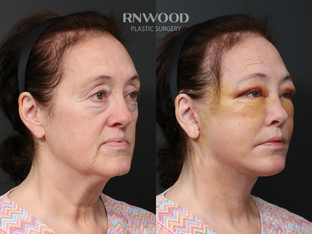 Deep Plane Facelift + Neck Contour — before and after, threeQuarterRight view, case 03