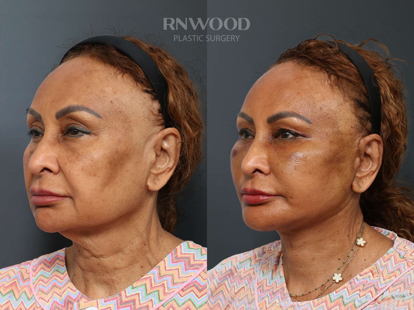 Deep Plane Facelift — before and after, threeQuarterLeft view, case 06