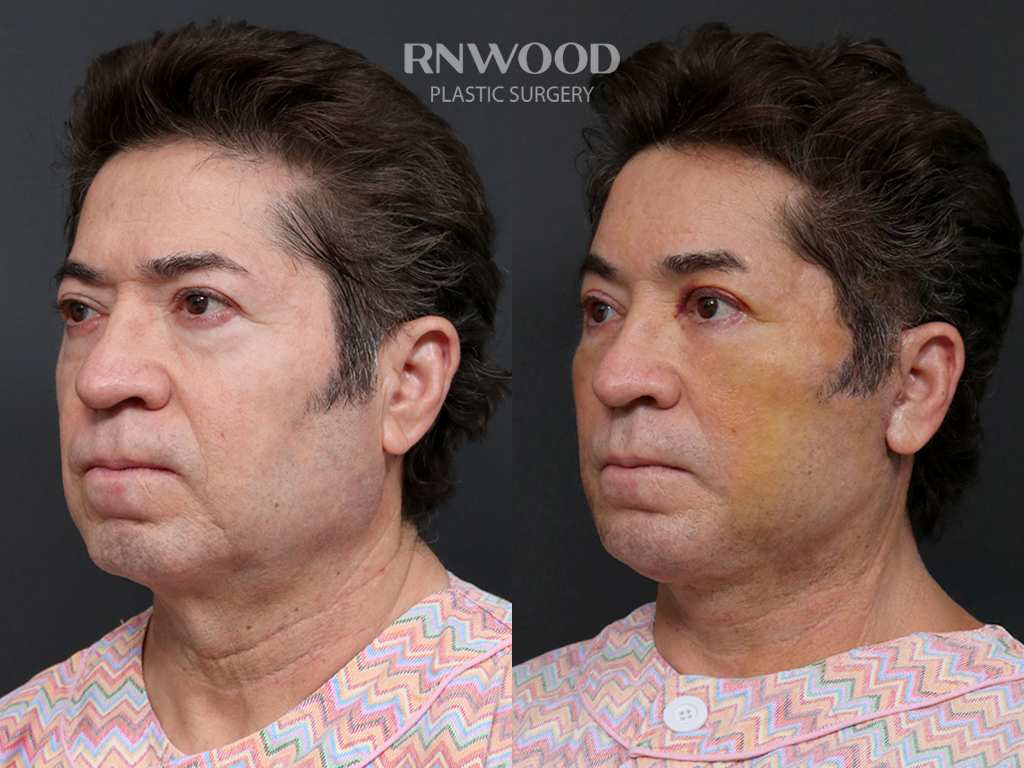 Deep Plane Facelift — before and after, threeQuarterLeft view, case 10