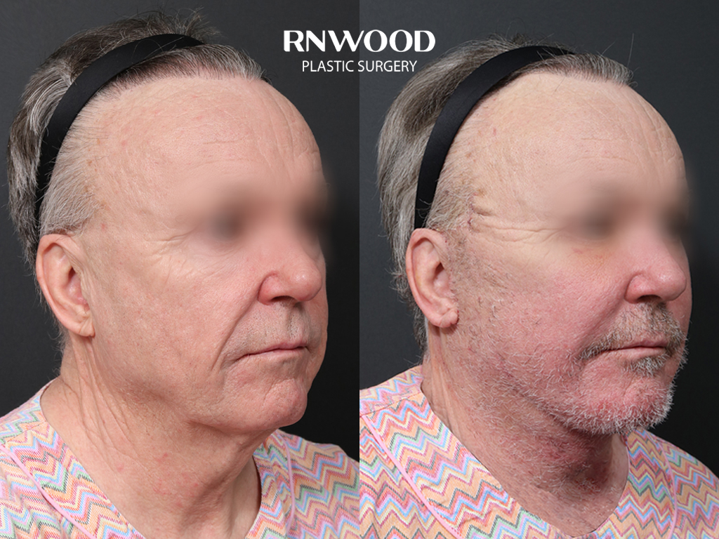 Deep Plane Facelift — before and after, threeQuarterRight view, case 01
