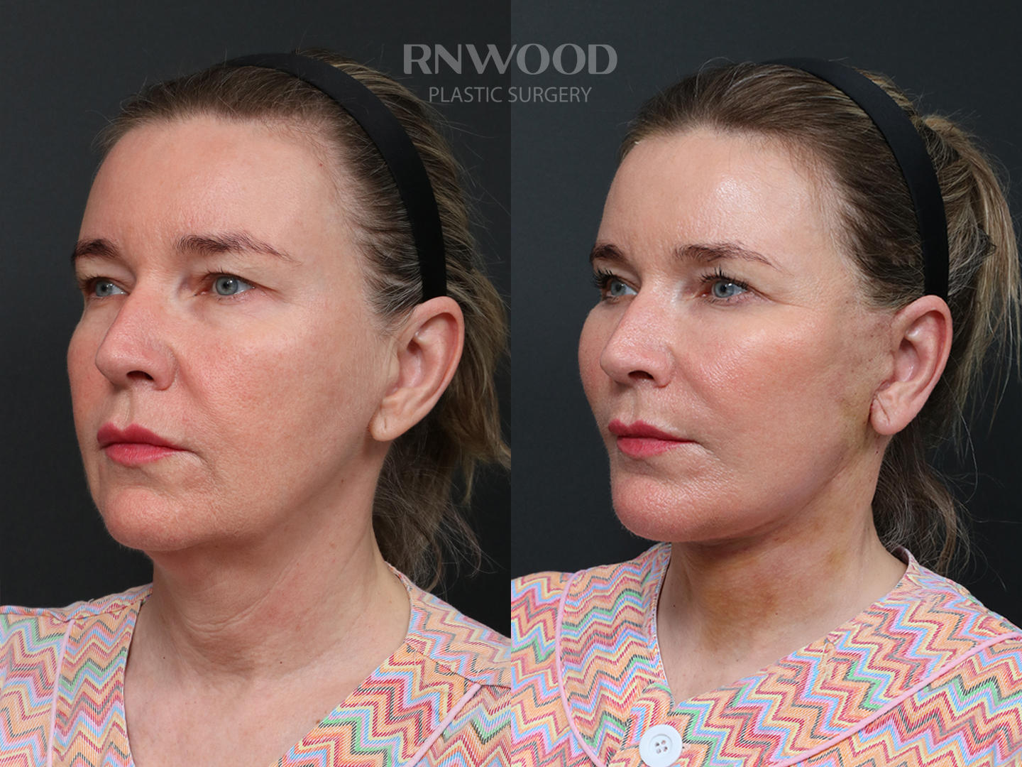Deep Plane Facelift — before and after, threeQuarterLeft view, case 05