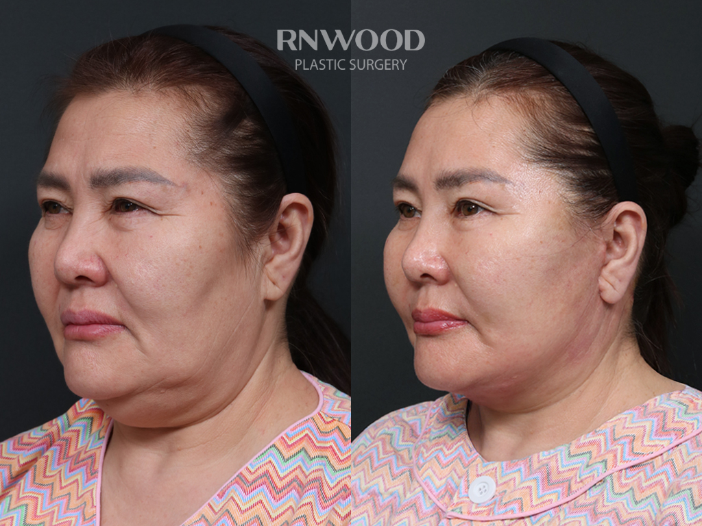 Deep Plane Facelift — before and after, threeQuarterLeft view, case 14