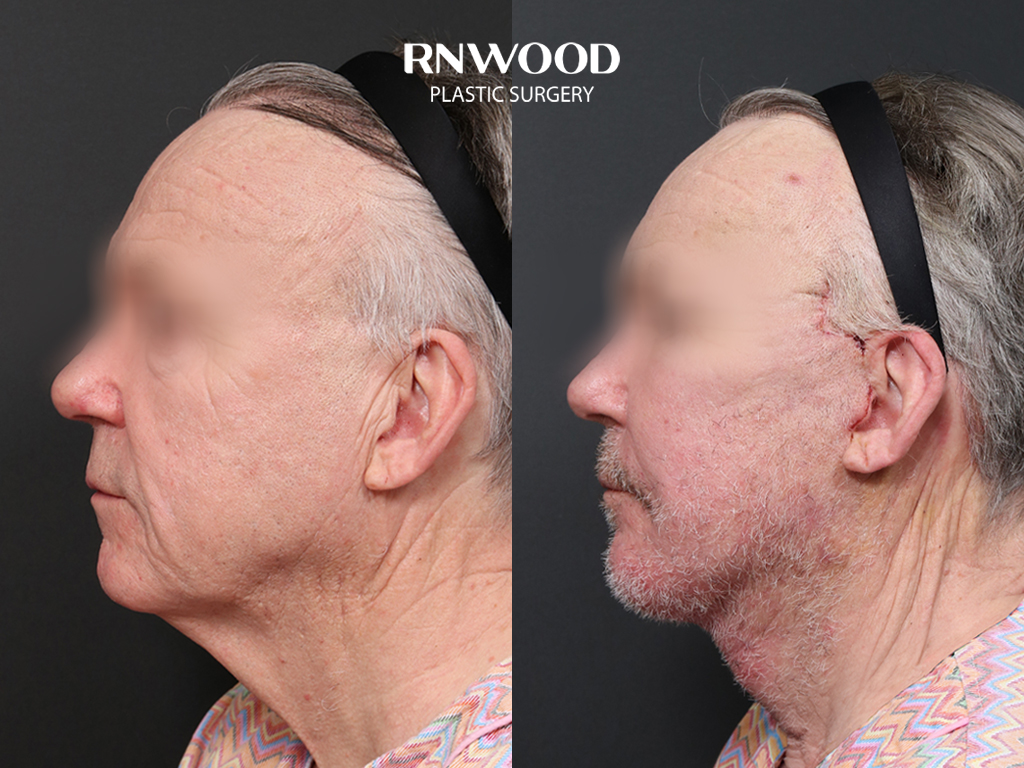 Deep Plane Facelift — before and after, profileLeft view, case 01