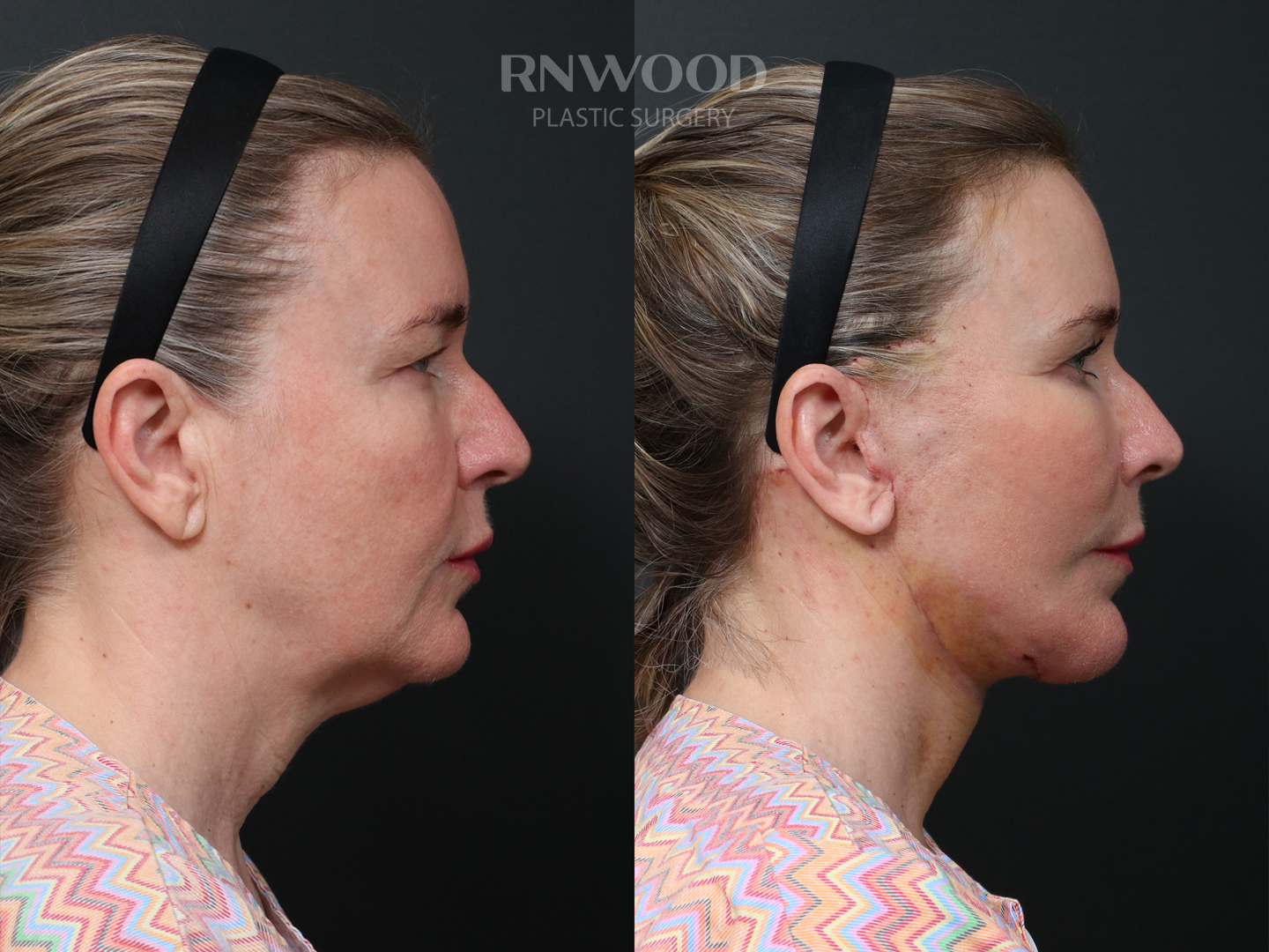 Right profile — case 05