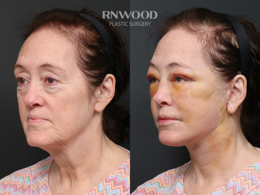 Deep Plane Facelift + Neck Contour — before and after, threeQuarterLeft view, case 03