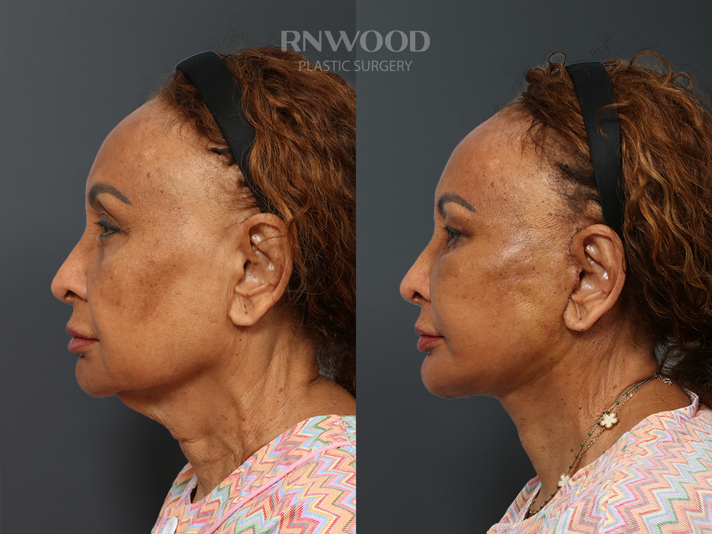 Left profile — case 06