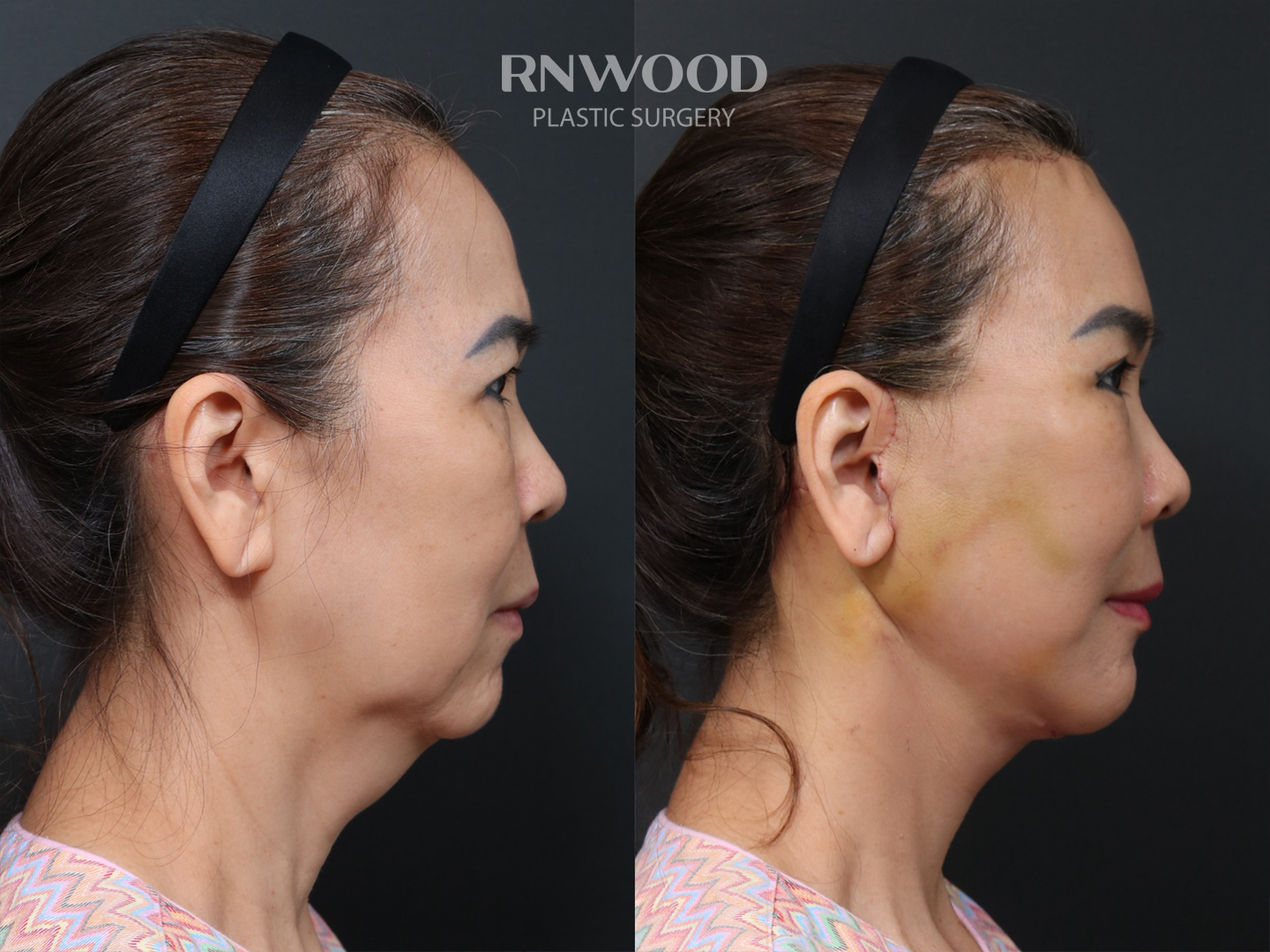 Right profile — case 12