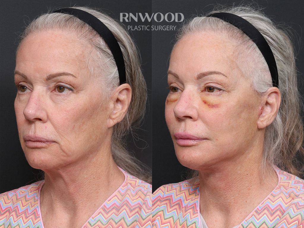 Revision Deep Plane Facelift — before and after, threeQuarterLeft view, case 07