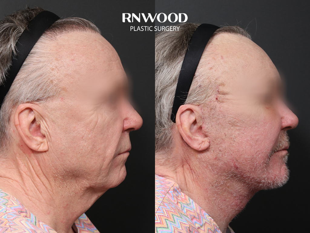 Deep Plane Facelift — before and after, profileRight view, case 01