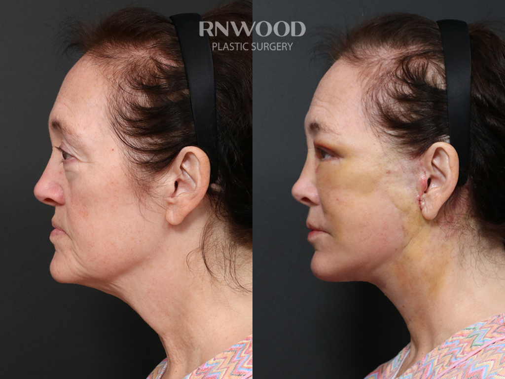 Deep Plane Facelift + Neck Contour — before and after, profileLeft view, case 03