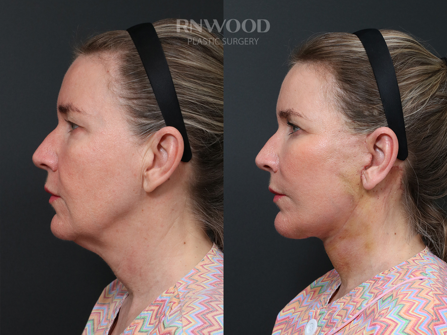 Left profile — case 05