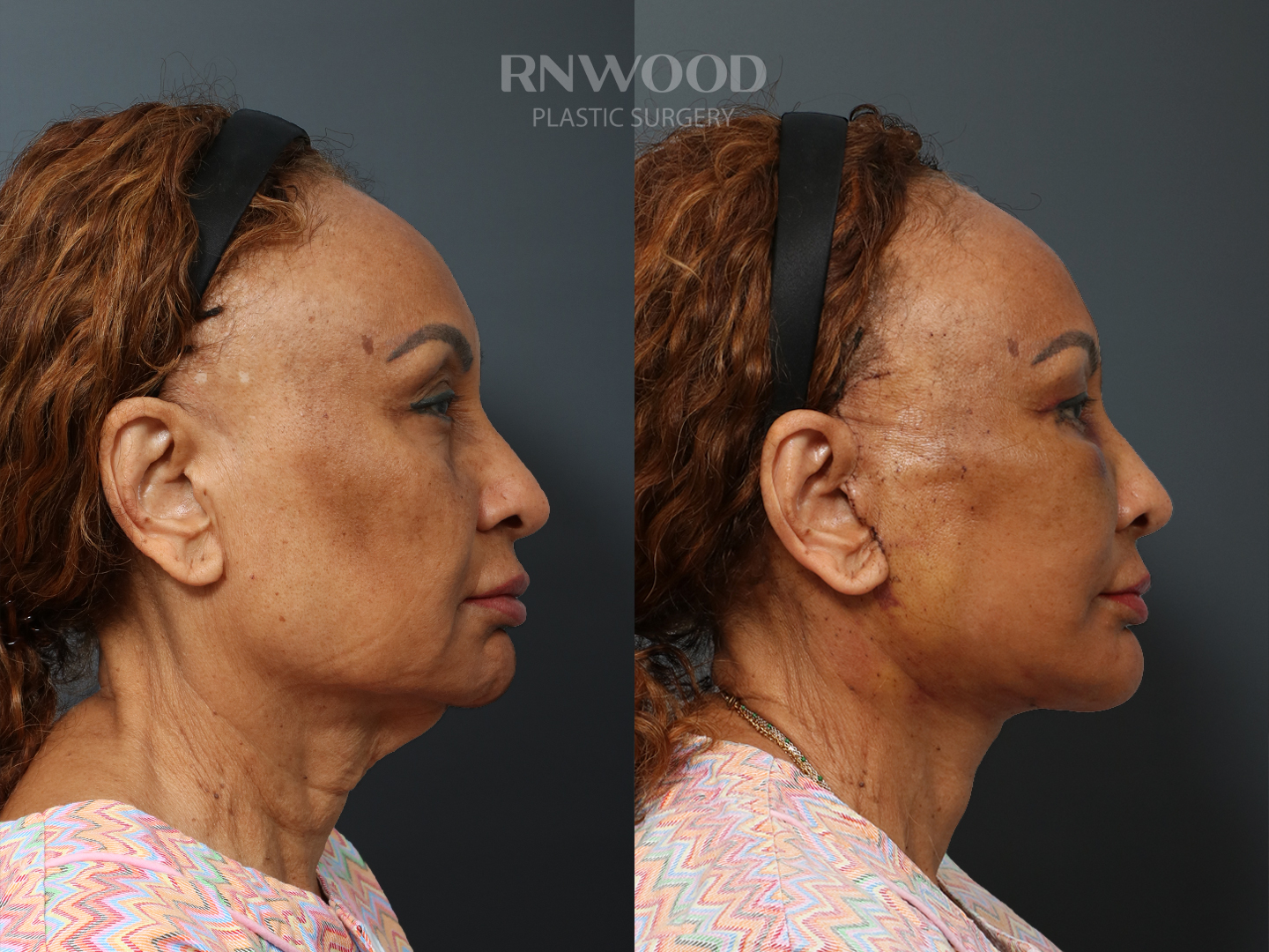 Right profile — case 06