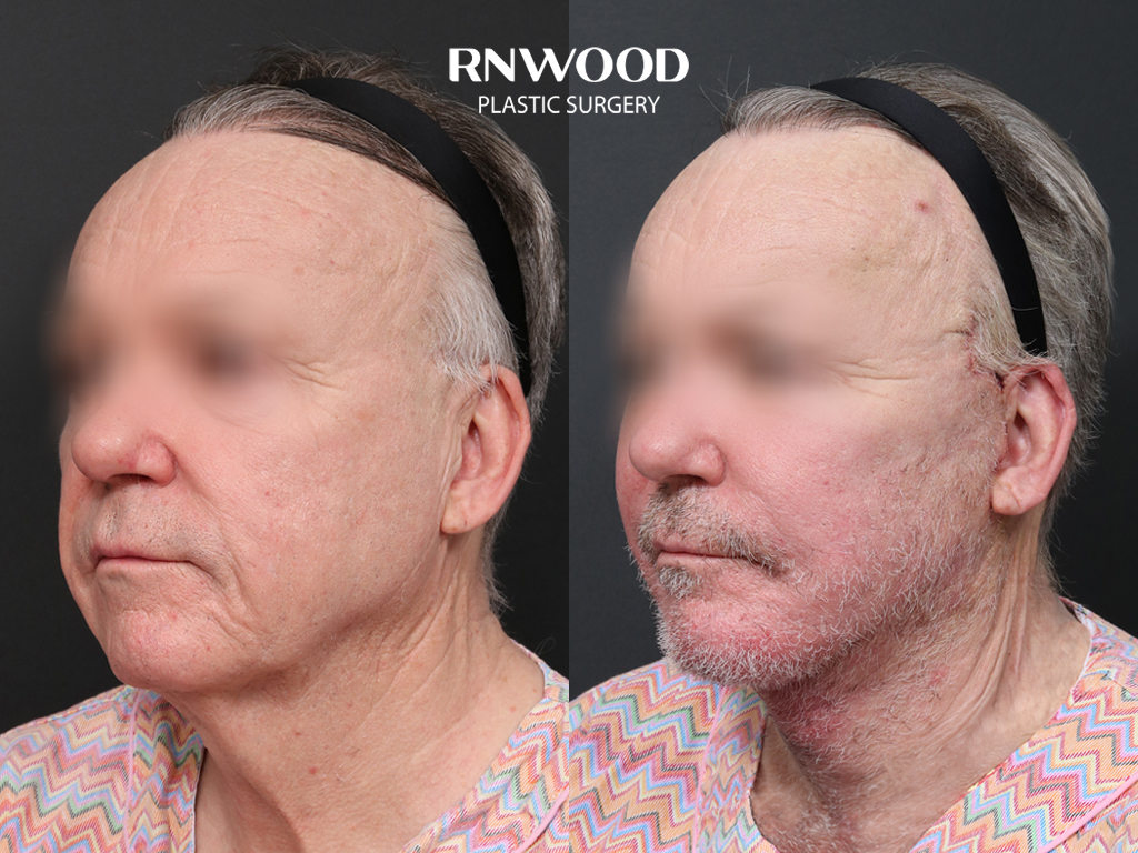 Deep Plane Facelift — before and after, threeQuarterLeft view, case 01