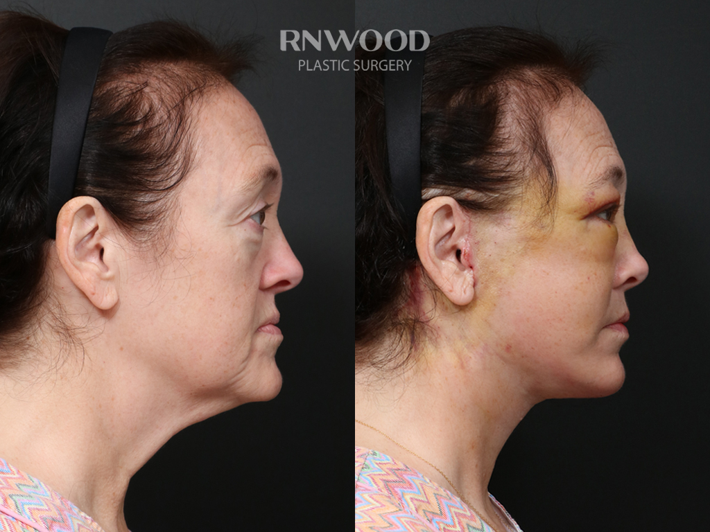 Deep Plane Facelift + Neck Contour — before and after, profileRight view, case 03