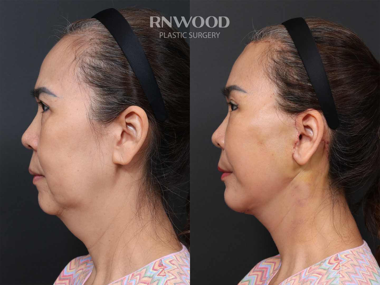 Left profile — case 12