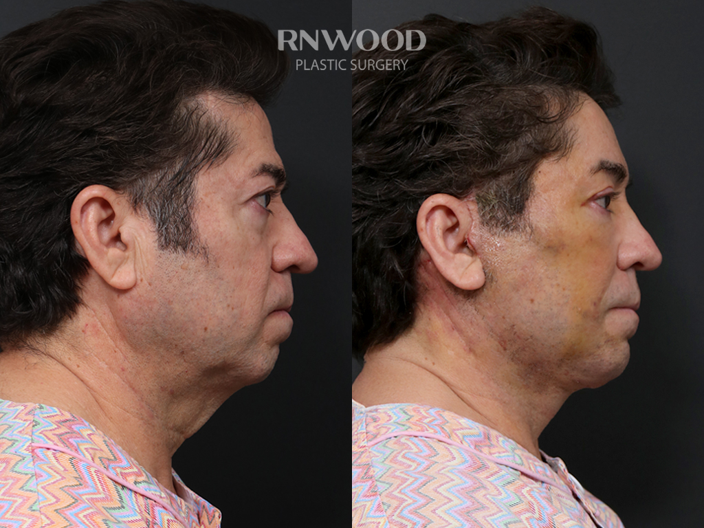 Right profile — case 10
