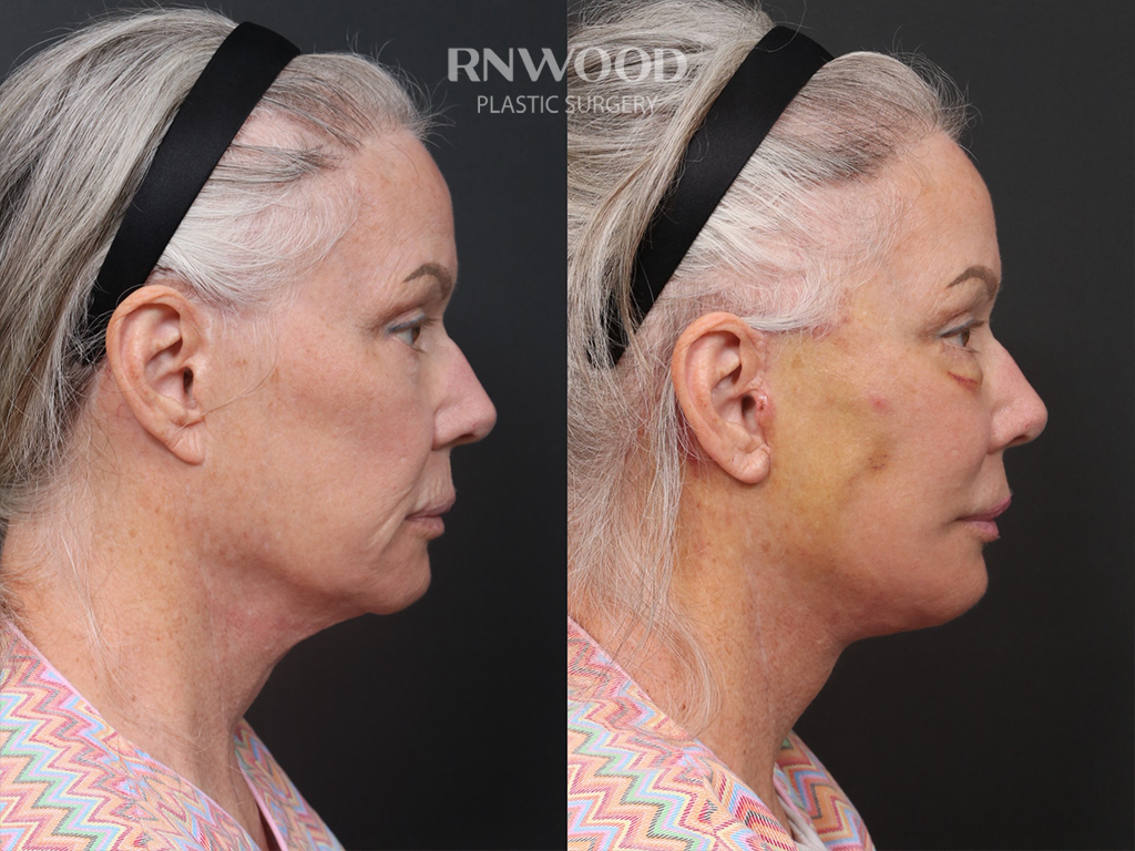 Right profile — case 07