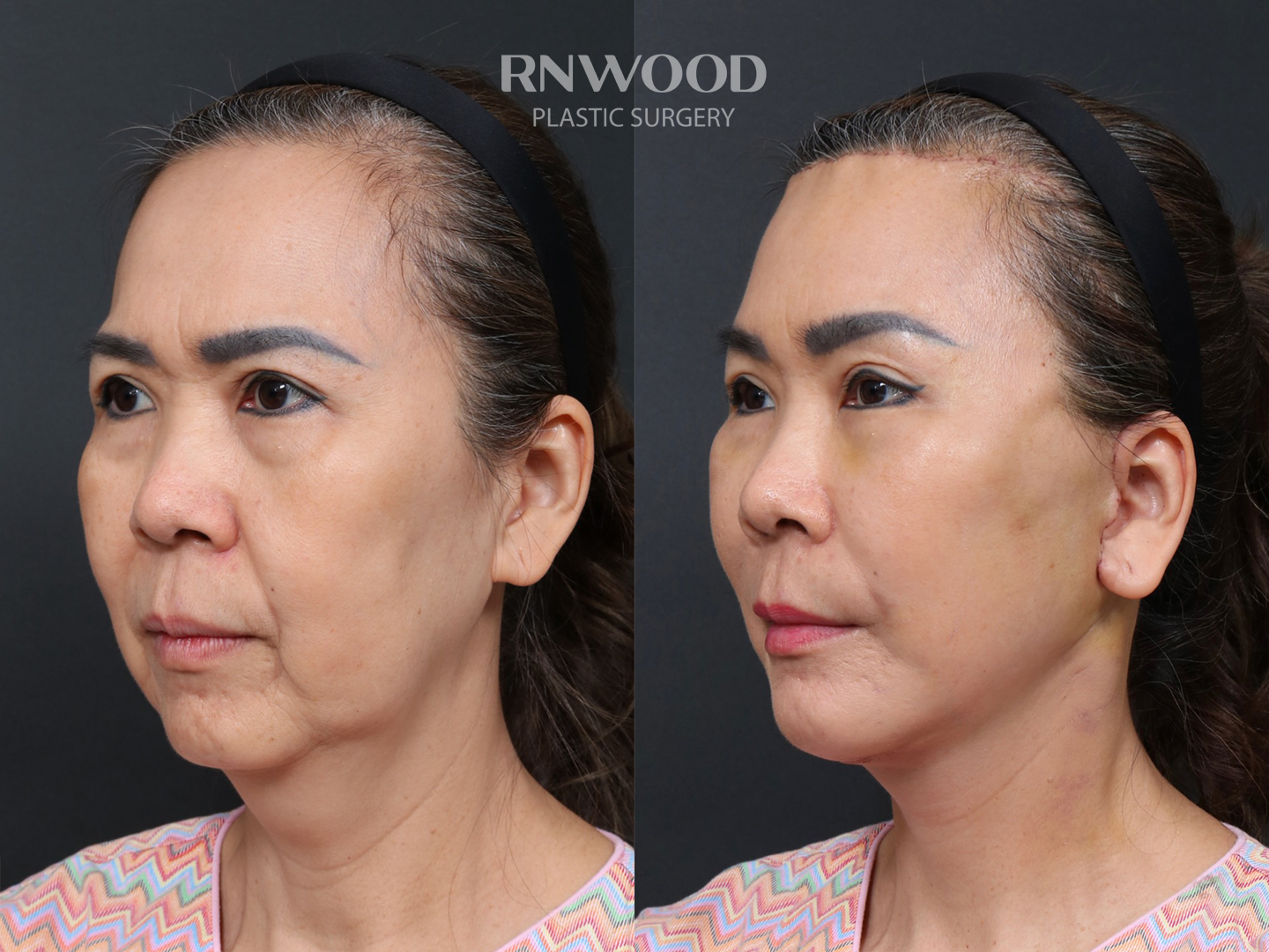 Deep Plane Facelift — before and after, threeQuarterLeft view, case 12