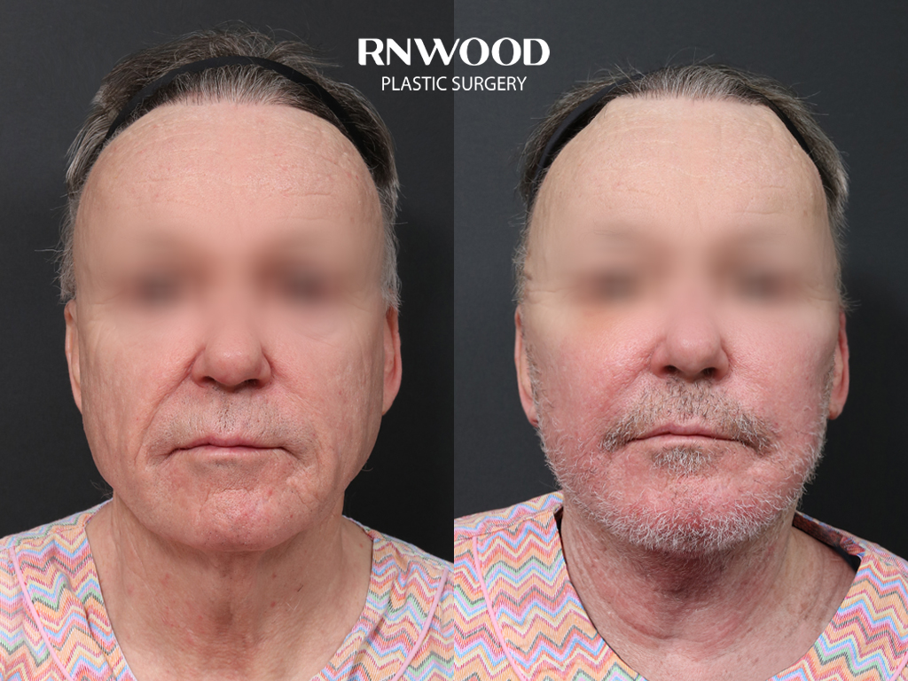 Deep Plane Facelift — before and after, front view, case 01