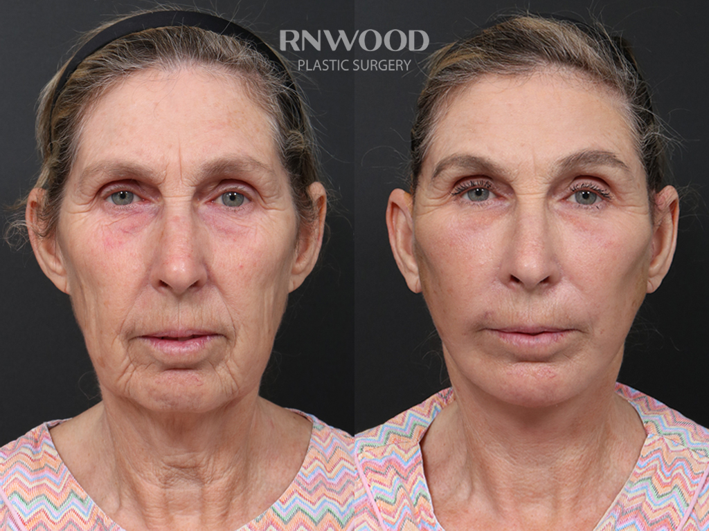 Deep Plane Facelift + Mid-Face — before and after, front view, case 02