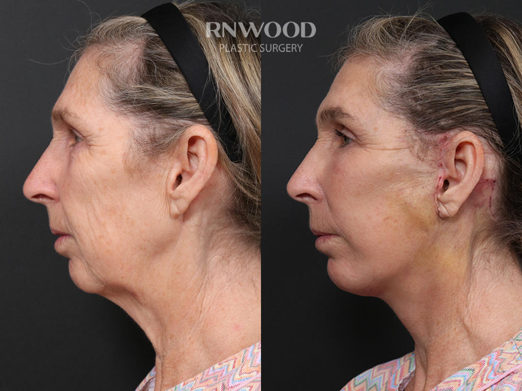 Deep Plane Facelift — before and after, profileLeft view, case 03