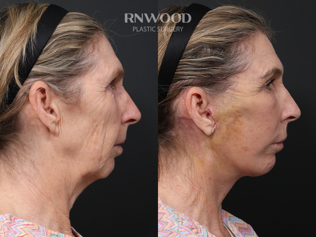 Deep Plane Facelift — before and after, profileRight view, case 03