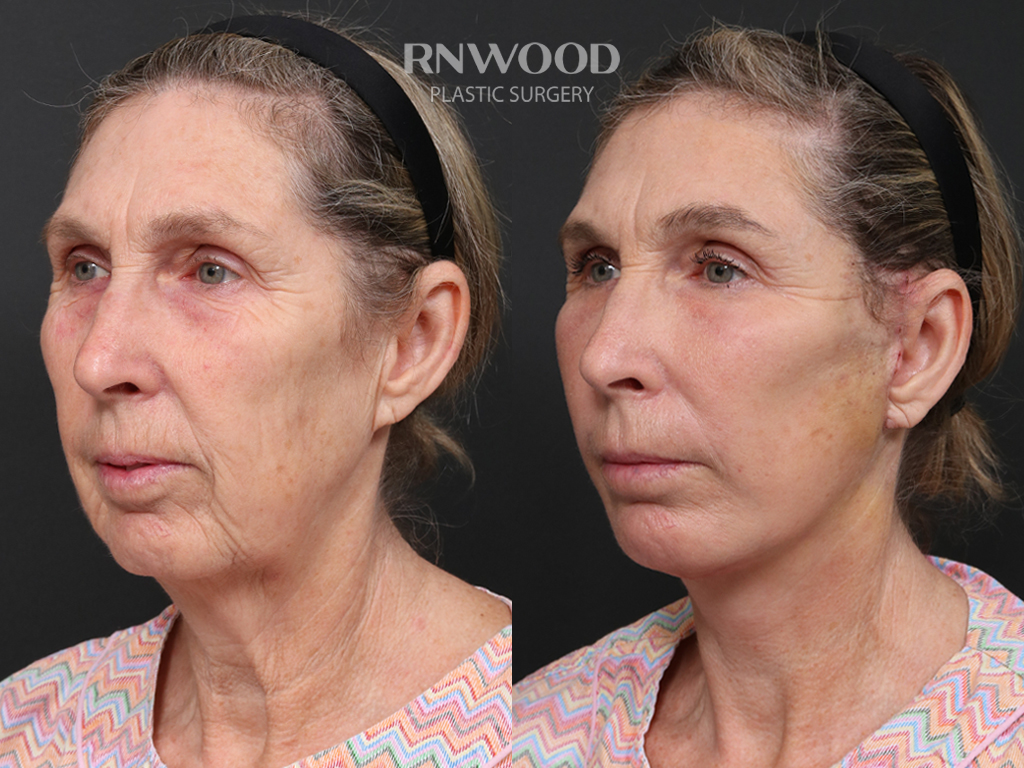 Deep Plane Facelift — before and after, threeQuarterLeft view, case 03
