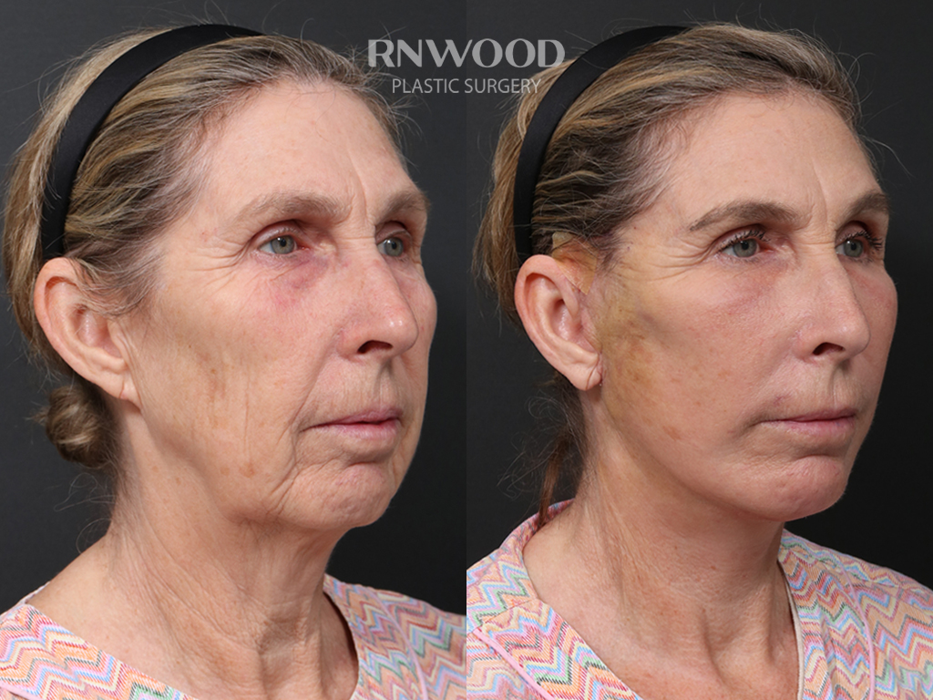 Deep Plane Facelift — before and after, threeQuarterRight view, case 03