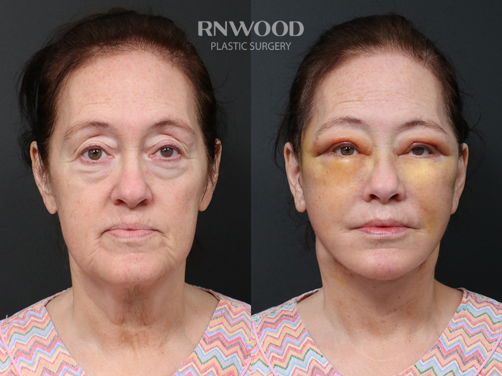 Deep Plane Facelift + Neck Contour — before and after, front view, case 03