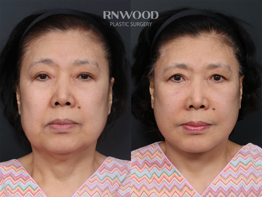 Deep Plane Facelift — before and after, front view, case 04