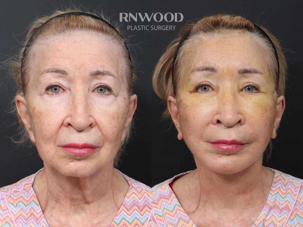 Revision Deep Plane Facelift — before and after, front view, case 05