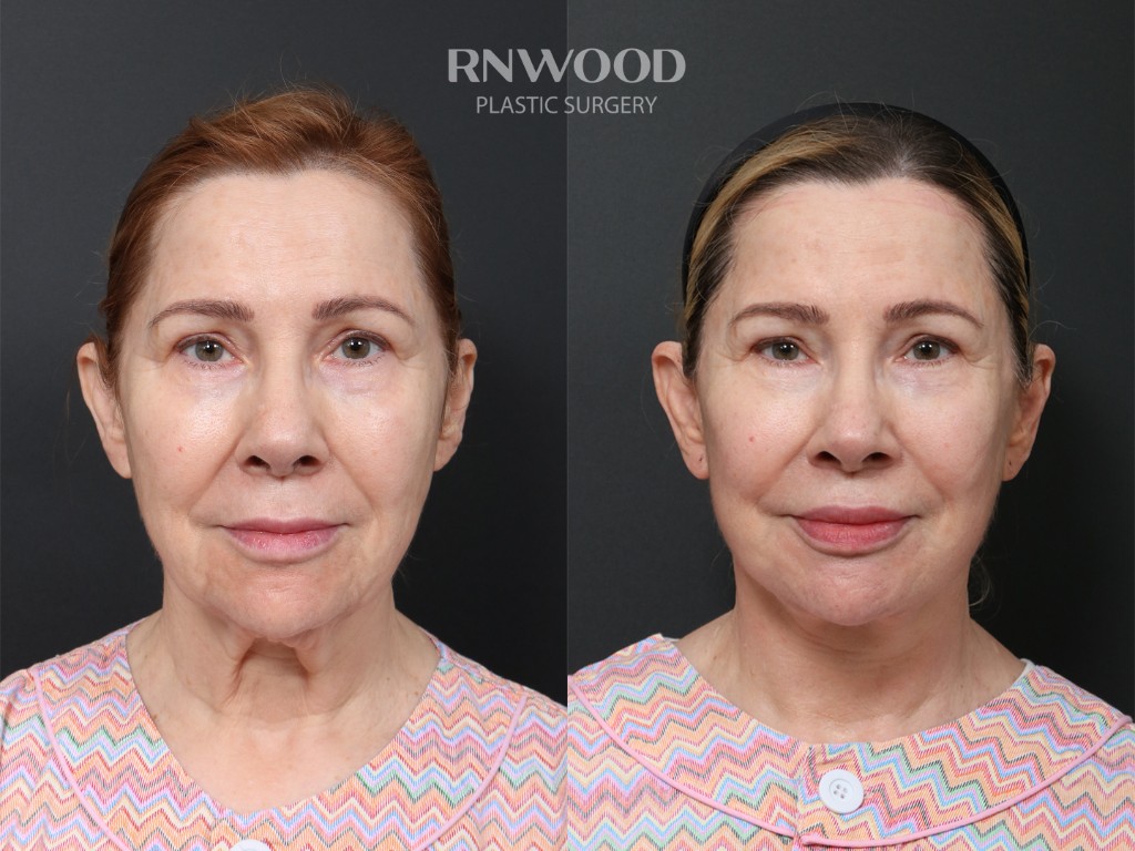 Deep Plane Facelift + Brow Lift — before and after, front view, case 06