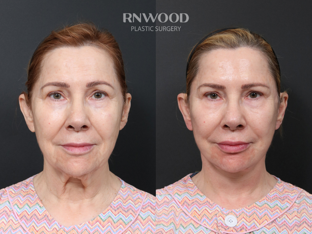 Deep Plane Facelift + Brow Lift — before and after, front view, case 06