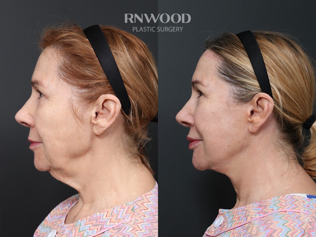 Deep Plane Facelift + Brow Lift — before and after, profileLeft view, case 06