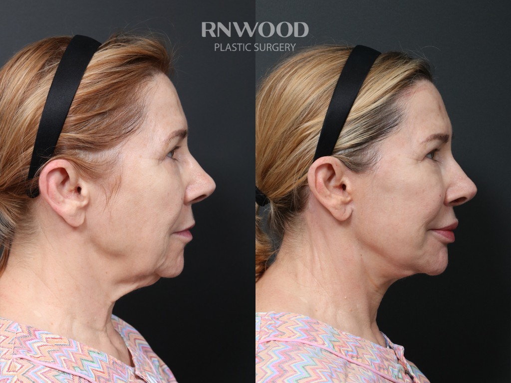 Deep Plane Facelift + Brow Lift — before and after, profileRight view, case 06