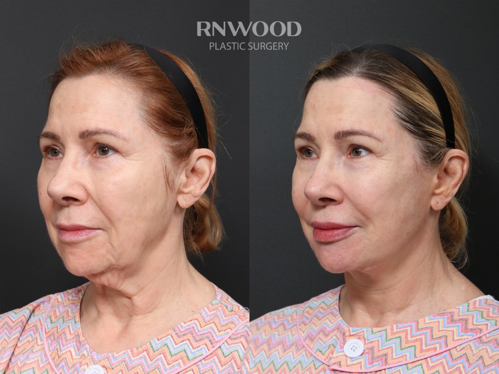Deep Plane Facelift + Brow Lift — before and after, threeQuarterLeft view, case 06