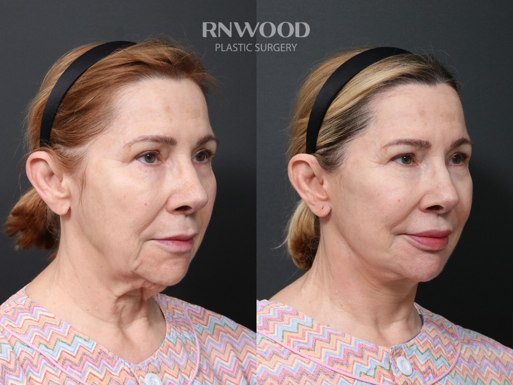 Deep Plane Facelift + Brow Lift — before and after, threeQuarterRight view, case 06