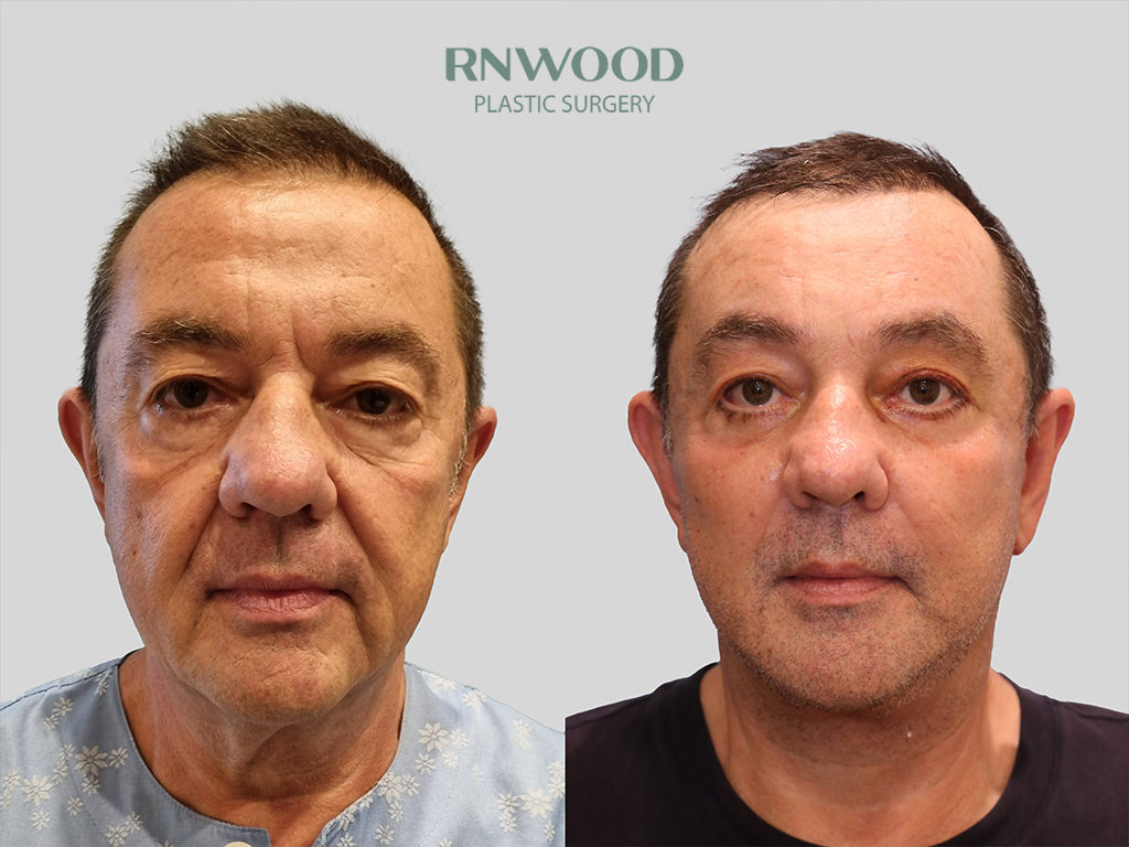 Deep Plane Facelift — before and after, front view, case 07