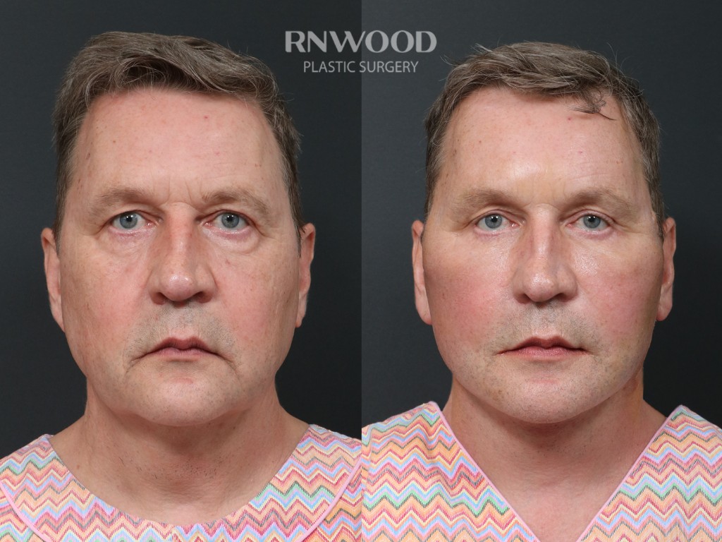 Deep Plane Facelift — before and after, front view, case 08