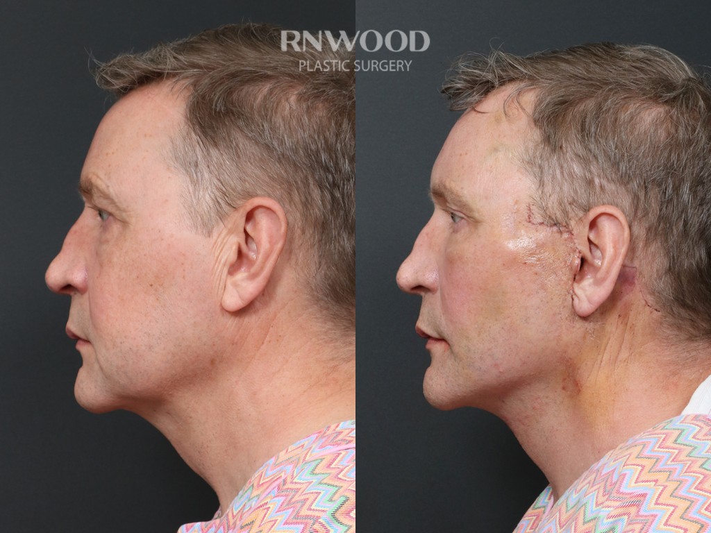 Deep Plane Facelift — before and after, profileLeft view, case 08